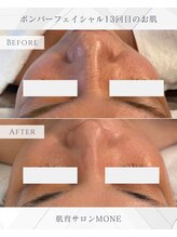 モネ オキナワ(MONE okinawa.)/１３回目のお肌