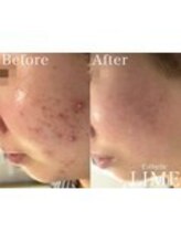 ベル 川越(Belle)/ハーブピーリング｜ニキビケア