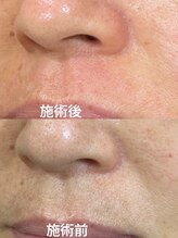 デフィ(Defi)/鼻下Wax