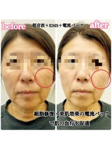 シルク(Cilk)/小顔たるみ美白1回の施術で変化