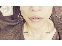 【美容皮膚科監修】GF細胞活性フェイシャルで若々しく.ハリ.弾力