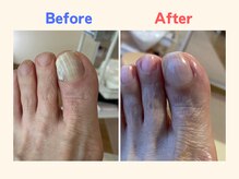 ピース/爪の変形に悩んでいた70代女性