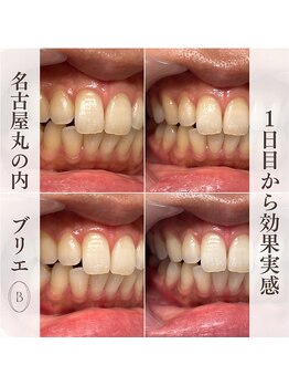 ブリエ(BRILLER)/高効果ホワイトニング　１デイ