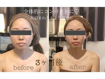 ラ フルール 折尾店/小顔矯正コルギ before→after