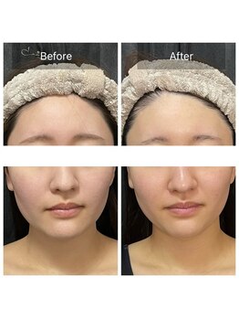 ジュエル シズオカ(JEWEL Shizuoka)/セルラム×コルギBefore After