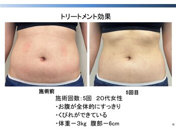 トラレス(Trouless)/脂肪冷却