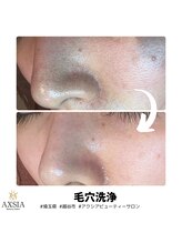 アクシア ビューティー サロン(AXSIA)/【毛穴洗浄】BeforeAfter