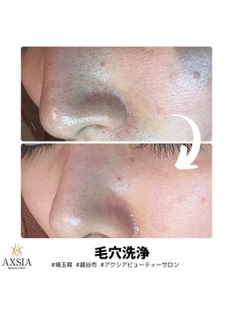 アクシア ビューティー サロン(AXSIA)/【毛穴洗浄】BeforeAfter