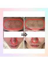 フレイヤビューティー スハダラボ 恵比寿(Freyia Beauty Suhada LABO)/-荒れがちなお肌に-恵比寿