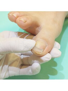 巻き爪補正店 鎌倉大船店/ 2.器具の選定を行う