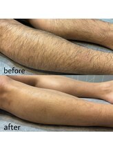 ヴィシアス(VIXIAS)/脱毛　施術1回　1ヶ月半後