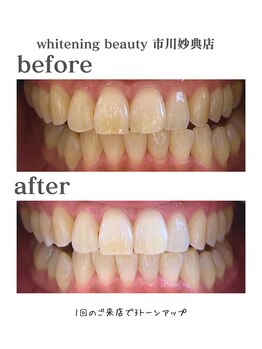 ホワイトニングビューティー 市川妙典店/歯科提携/ホワイトニング/妙典