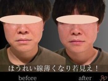 チョコバリ 渋谷店(chocobari)/小顔×リフトアップ(美容鍼)20代