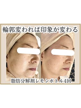 小顔になりたい