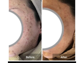 モカ 天王寺店(MOKA)/おでこニキビケア　くすみ