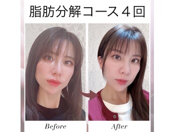 リジュベネ(rejuvena)の写真/【渡韓せずに最新美容！脂肪分解で二重あごとさよなら♪理想の輪郭へ】男女問わず施術可◎40代男性急増中！