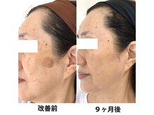 グランピピ(Grand PiPi)/肌「シミ」改善