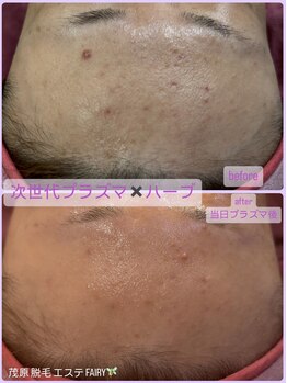 フェアリー/ダブル効果の肌質改善へ