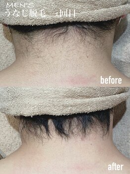 エムズスタイル ネイルバー(M's Style NAIL BAR)/うなじ脱毛