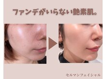 フェイスプラスリフ(FACE+RiF)