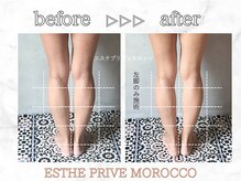 エステプリヴェモロッコ(ESTHE PRIVE MOROCCO)/人気No.1カッサ痩身