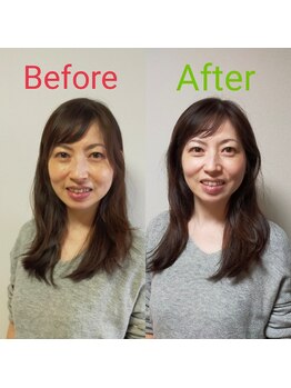 シャルム(Charme)/小顔矯正施術１回