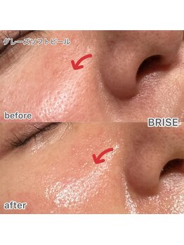 ブライズ(BRISE)/グレーズソフトピール