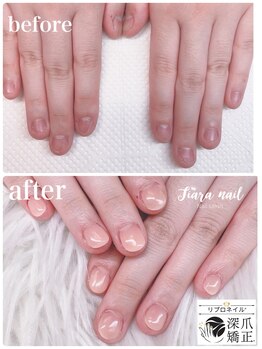 ティアラネイル 宇都宮/リプロネイル深爪矯正コース