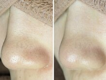 美鼻ラボ 押上 曳舟/毛穴エクストラクションプロ