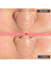 エクラリール(eclat rire)/～毛穴エクストラクション～