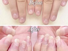 トラストネイル 佐野店(TRUST Nail)/深爪矯正の変化