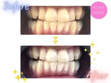 エクシアホワイトニング 札幌中島公園店/BeforeAfter［ホワイトニング］ 