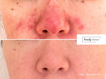 ビューティー ブロッサム(Beauty Blossom)/