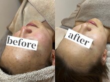 モンレーヴ(MonReve)/ハーブピーリング