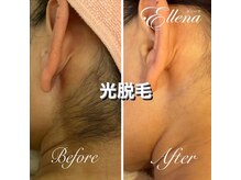 エレーナ 横浜(Ellena)/うなじ脱毛