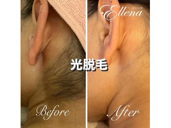 エレーナ 横浜(Ellena)/うなじ脱毛