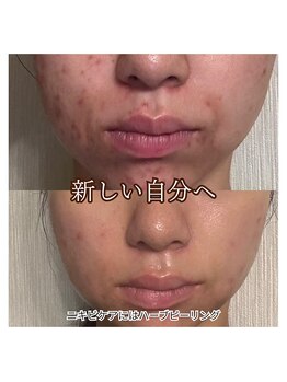 サロンドオフ 西梅田(salon de off)/ニキビケアのビフォーアフター