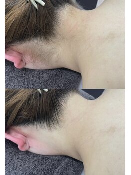 カルディエ(Cardie)/うなじ脱毛　ビフォーアフター