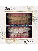 ホワイトニングショップ 宇都宮店/Before&After美白ホワイトニング
