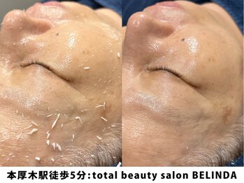 ベリンダ(BELINDA)/セルマンピーリング