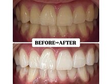ホワイトニングサロン 豊中/Before&After美白ホワイトニング