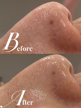 リリーミー(Rily Me)/Hy Peel 毛穴フェイシャル