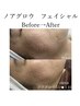 満足度No.1【水光肌・肌管理特化】ノアグロウ導入 ＜全顔+首＞ 