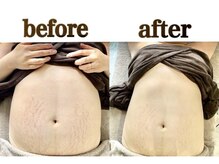 ミセル(MISEL2nd)/産後の肌ケアにWINBACK★