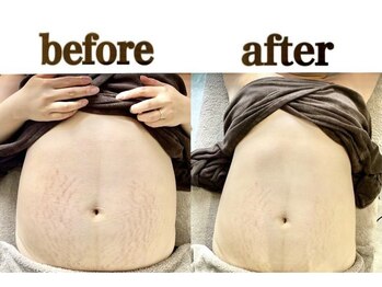 ミセル(MISEL2nd)/産後の肌ケアにWINBACK★