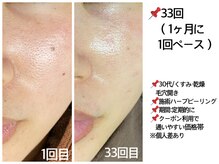 おうちサロン ミキ/30代毛穴悩み