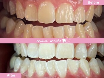 エクシアホワイトニング 札幌中島公園店/Before After［ホワイトニング］