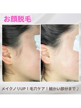 ヴィ シェーン(Vi Schoen)の写真/顔の産毛もスッキリ！細かい所までキレイに整えます♪2回目以降も通いやすい価格設定で、理想の素肌へ◎