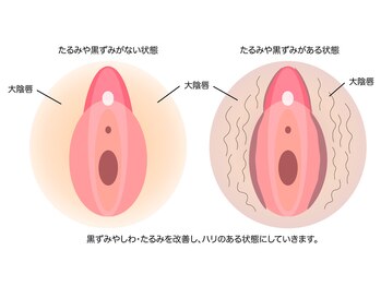 カナウ(KANAU)/VIO脱毛で黒ずみ解決！