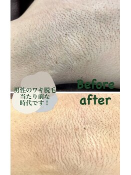 ツリービューティー(Tree Beauty)/★男性ワキ脱毛当たり前です!★